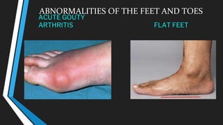 ABNORMALITIES OF THE FEET AND TOES
ACUTE GOUTY
ARTHRITIS FLAT FEET
 