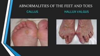 ABNORMALITIES OF THE FEET AND TOES
CALLUS HALLUX VALGUS
 
