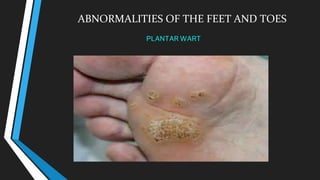 ABNORMALITIES OF THE FEET AND TOES
PLANTAR WART
 