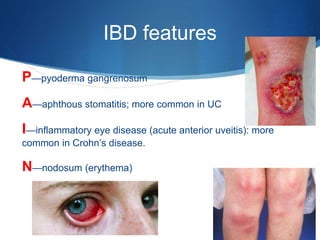 IBD features
 P—pyoderma gangrenosum
 A—aphthous stomatitis; more common in UC
 I—inflammatory eye disease (acute anterior uveitis): more
common in Crohn’s disease.
 N—nodosum (erythema)
 