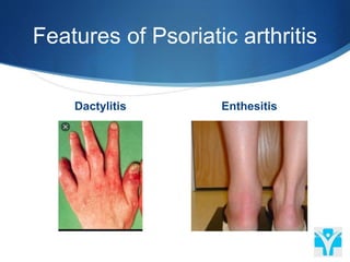 Features of Psoriatic arthritis
Dactylitis Enthesitis
 
