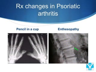 Rx changes in Psoriatic
arthritis
Pencil in a cup Enthesopathy
 