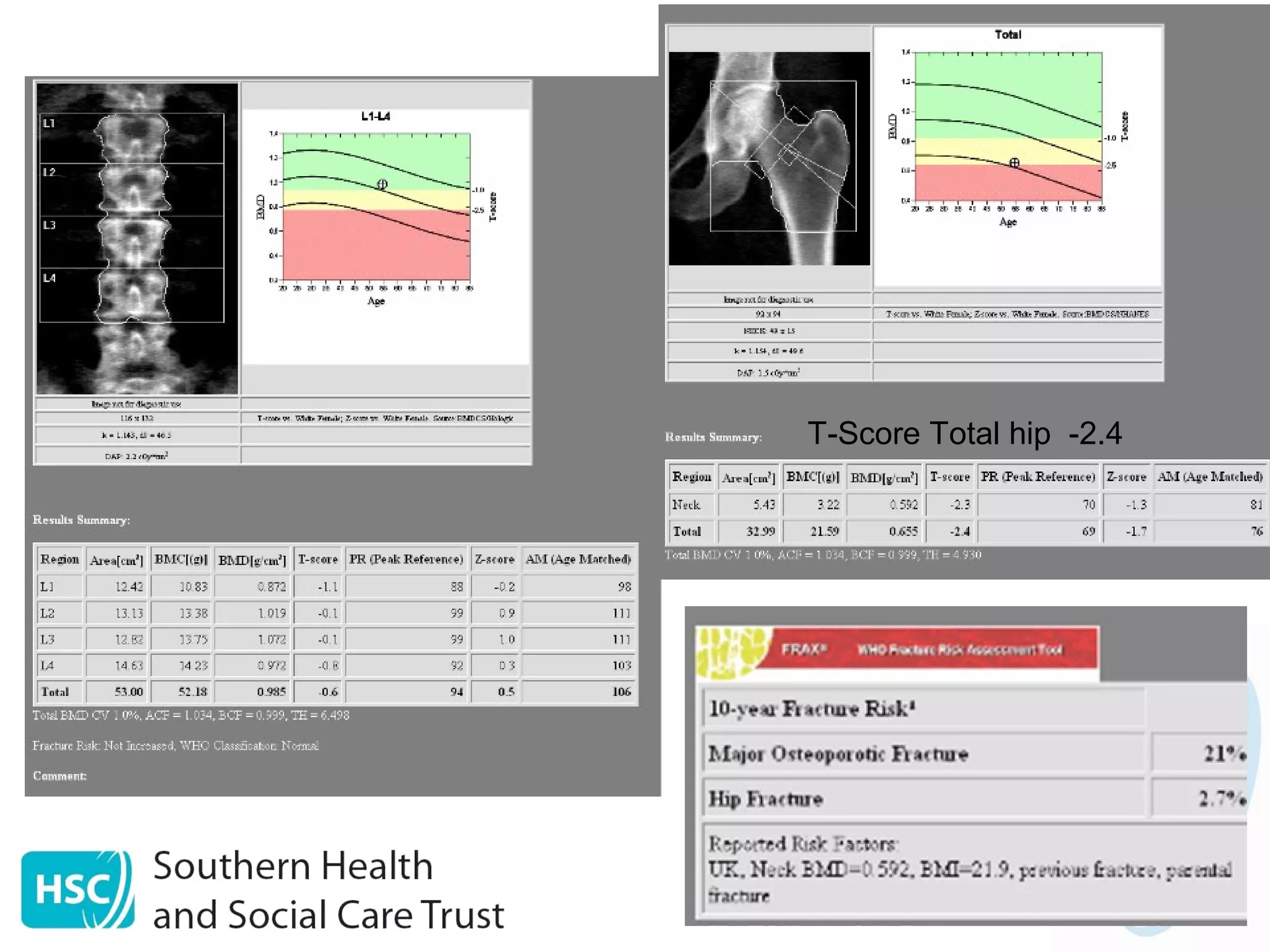 Fracture Risk Scale Scoring Assessing Fracture Risk | PPT