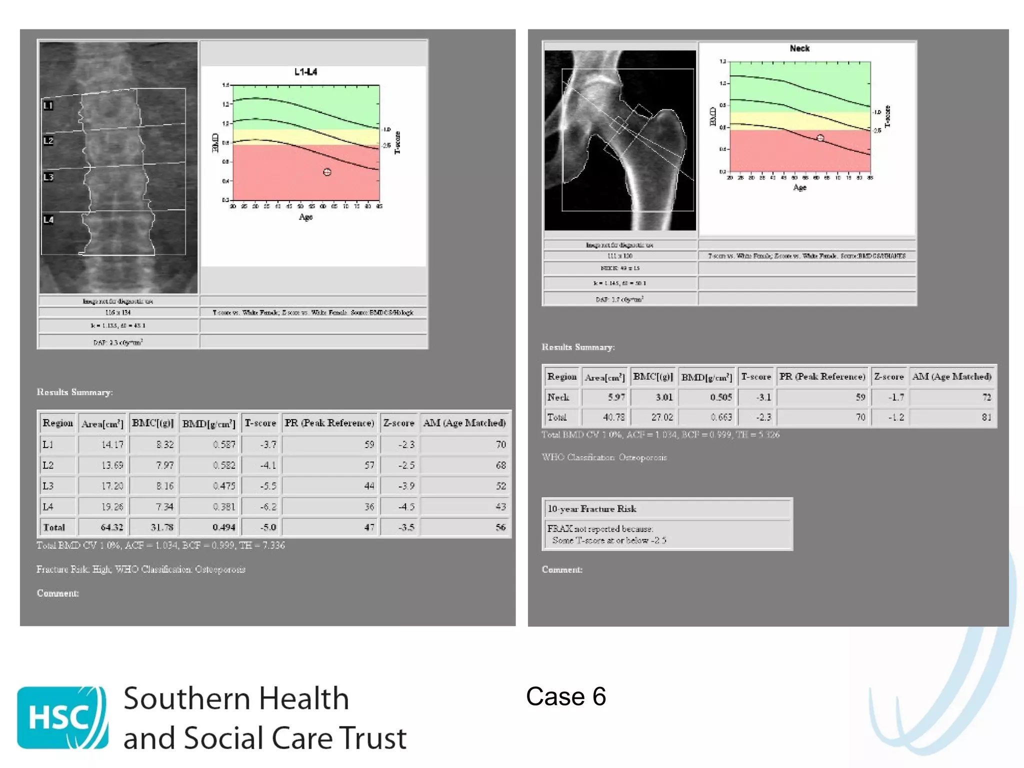 Assessing Fracture Risk | PPT
