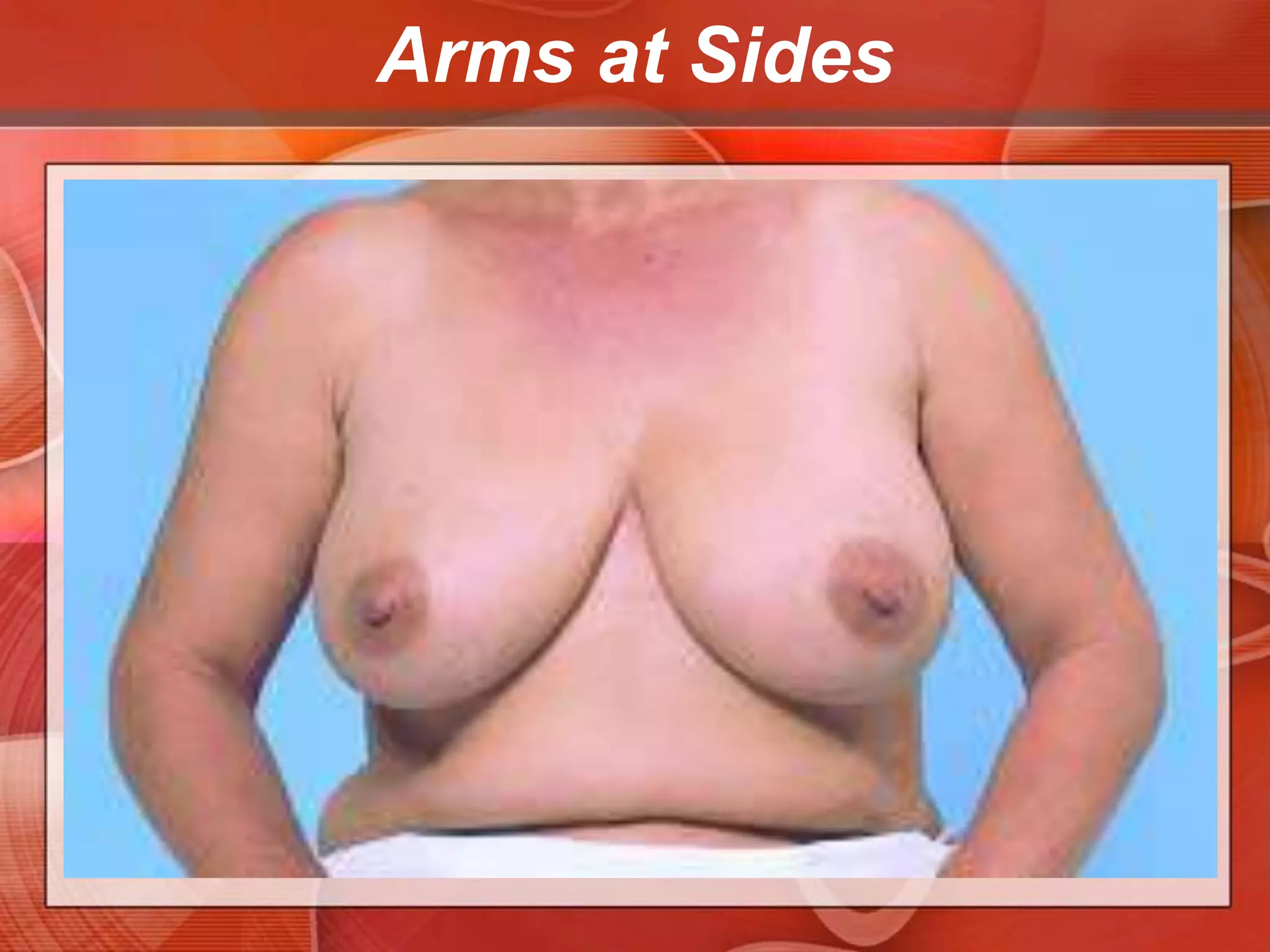 Arms at SidesAppearance of the skinColorThickening of the skin and unusually prominent pores, which may accompany lymphatic obstructionRedness from local infection or inflammatory carcinomaThickening and prominent pores suggest a breast cancer.