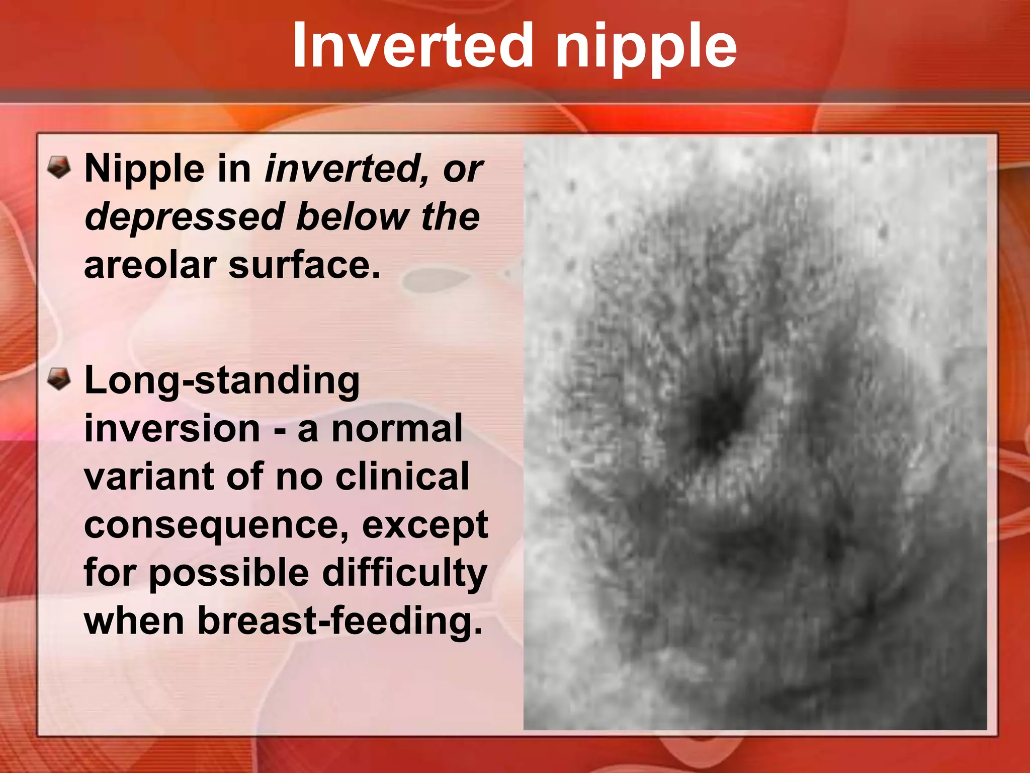 Recent or fixed flattening or depression of the nipple suggests nipple retraction. A retracted nipple may also be broadened and thickened.
