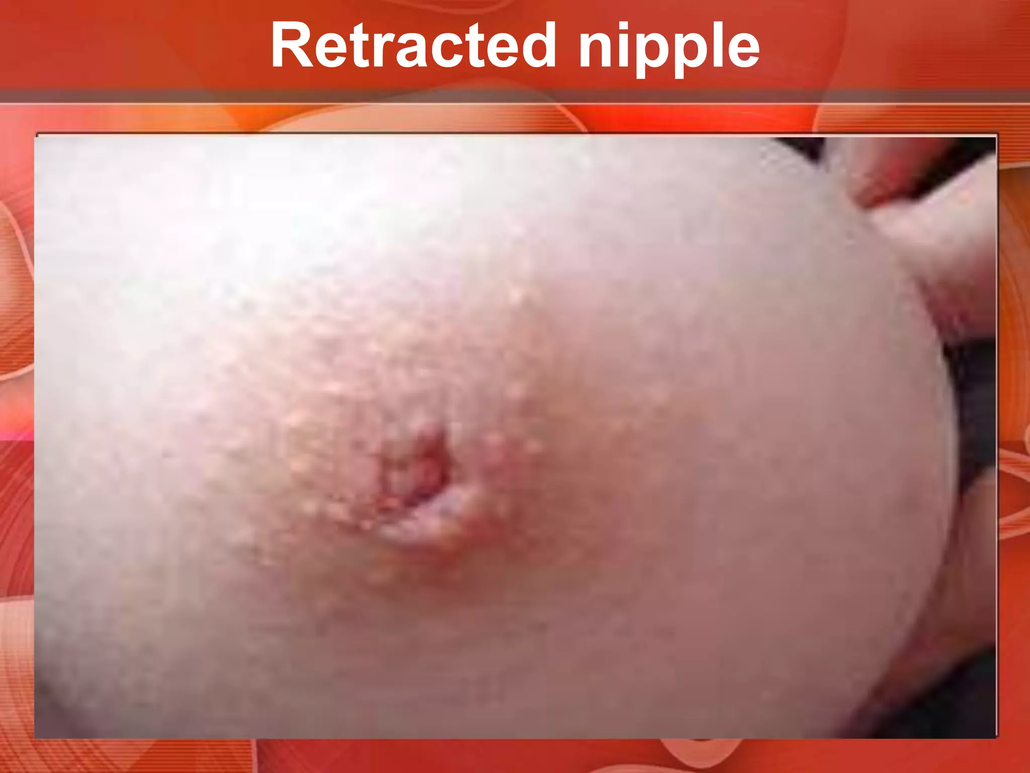 Inverted nippleNipple in inverted, or depressed below the areolar surface. Long-standing inversion - a normal variant of no clinical consequence, except for possible difficulty when breast-feeding.