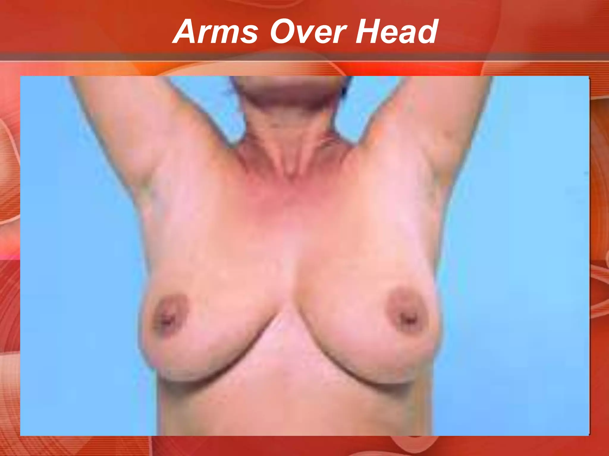 To bring out dimpling or retraction that may otherwise be invisibleAsk the patient to raise her arms over her head, then press her hands against her hips to contract the pectoral muscles. Inspect the breast contours carefully in each position. If the breasts are large or pendulous, it may be useful to have the patient stand and lean forward, supported by the back of the chair or the examiner’s hands.