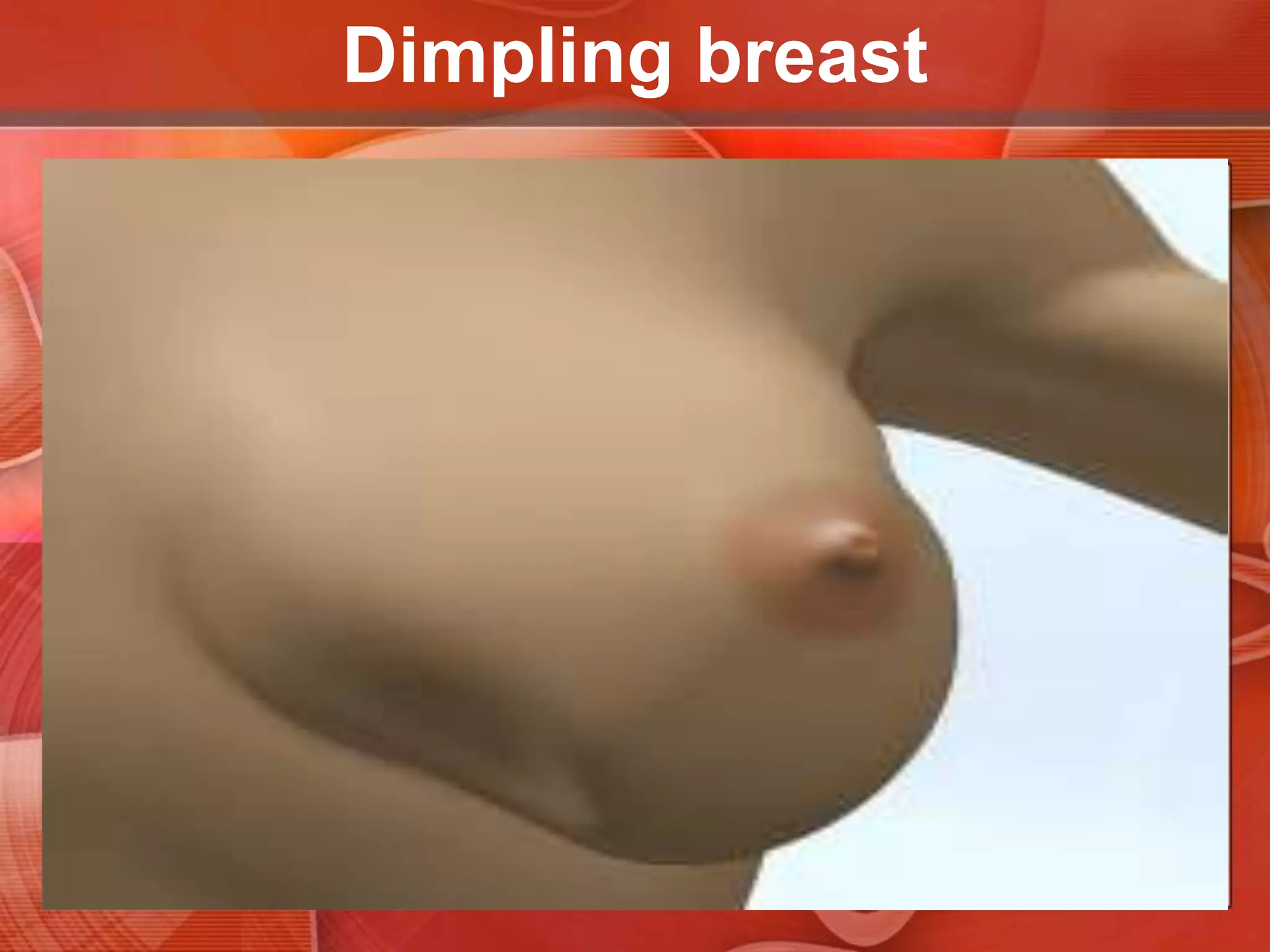 Dimpling or retraction of the breastsWhen a cancer or its associated fibrous strands are attached to both the skin and the fascia overlying the pectoral muscles, pectoral contraction can draw the skin inward, causing dimpling.
