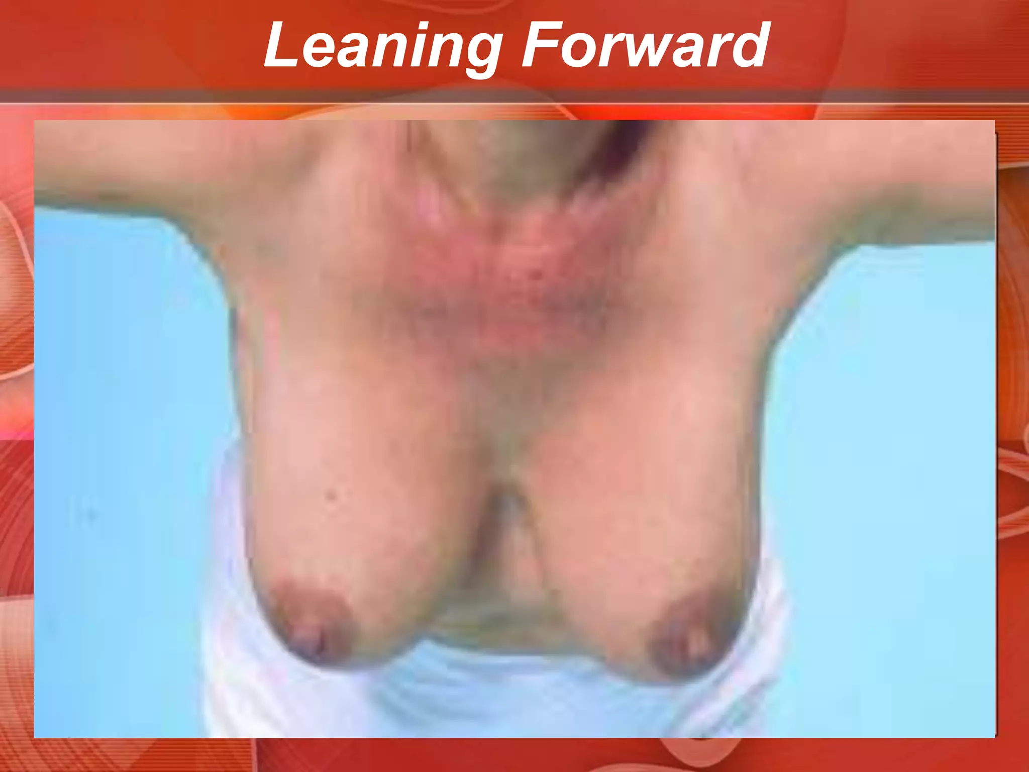 Hands Pressed Against HipsBenign lesions Posttraumatic fat necrosis or mammary duct ectasia