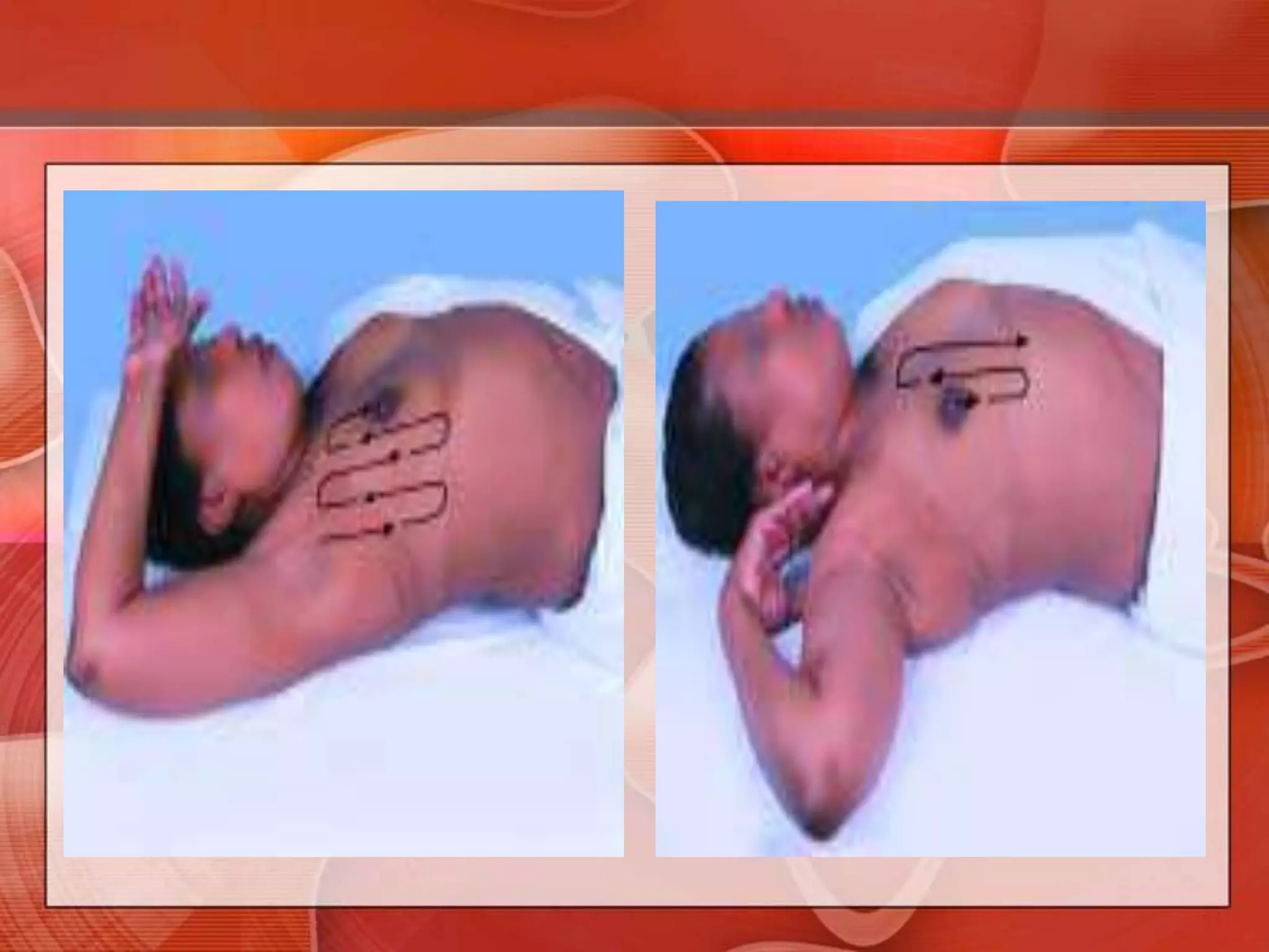 Begin palpation in the axilla, moving in a straight line down to the bra line, then move the fingers medially and palpate in a vertical strip up the chest to the clavicle. Continue in vertical overlapping strips until you reach the nipple, then reposition the patient to flatten the medial portion of the breast.Nodules in the tail of the breast are sometimes mistaken for enlarged axillary lymph nodes (and vice versa).