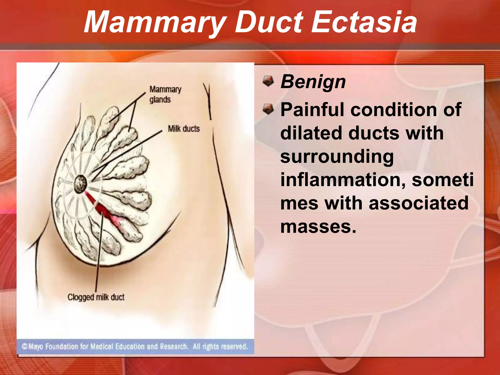 Examine the breast tissue carefully for:There may be a firm transverse ridge of compressed tissue along the lower margin of the breast, especially in large breasts. This is the normal inframammary ridge, not a tumor.Tender cords suggest mammary duct ectasia, a benign but sometimespainful condition of dilated ducts with surrounding inflammation, sometimes with associatedmasses.