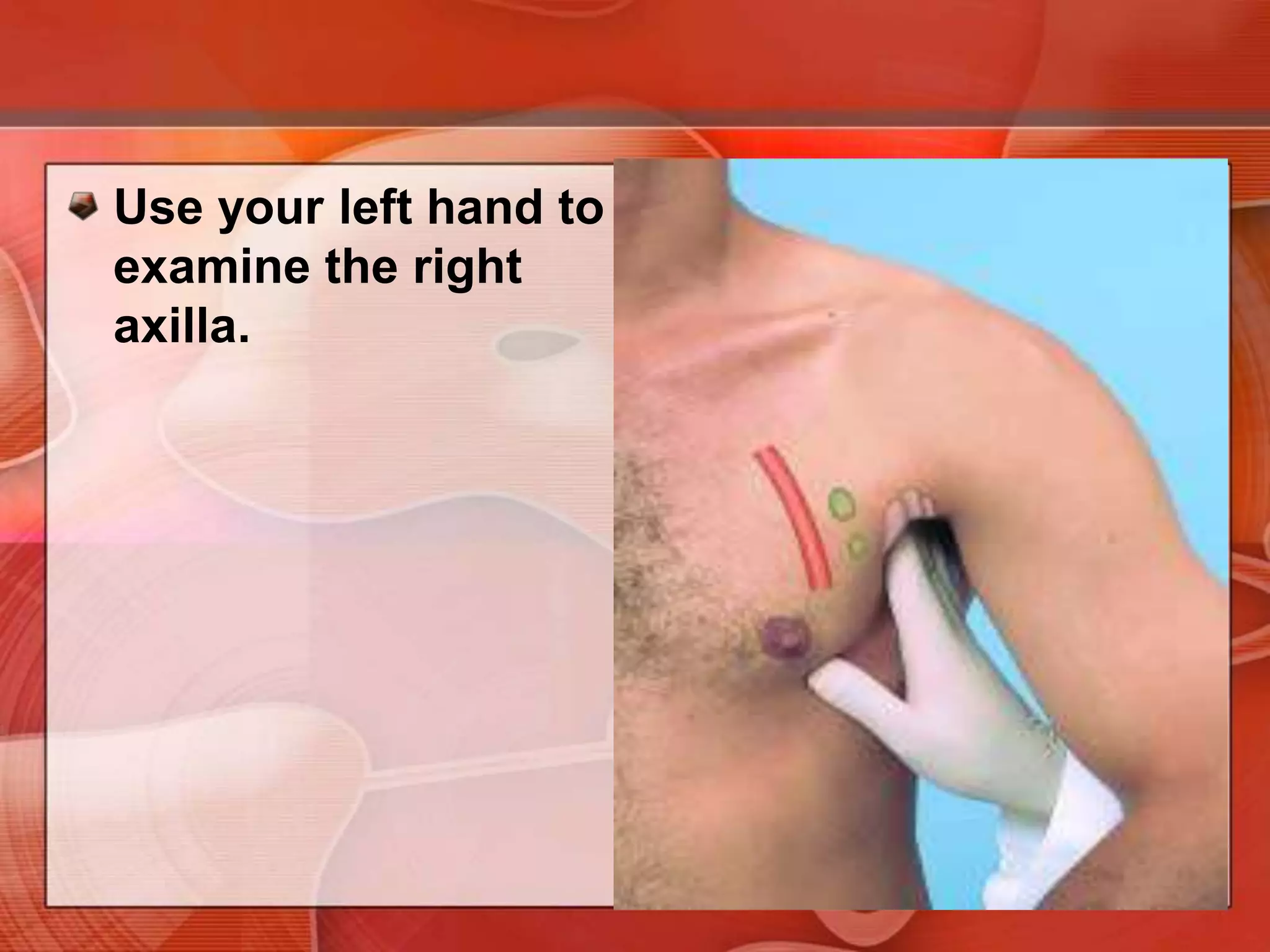 PALPATION: ABNORMALITIESEnlarged axillary nodes from infection of the hand or arm, recent immunizations or skin tests in the arm, or part of a generalized lymphadenopathy. Check the epitrochlear nodes and other groups of lymph nodes.Nodes that are large (≥1 cm) andfirm or hard, matted together, or fixed to the skin or to underlying tissues suggest malignant involvement.