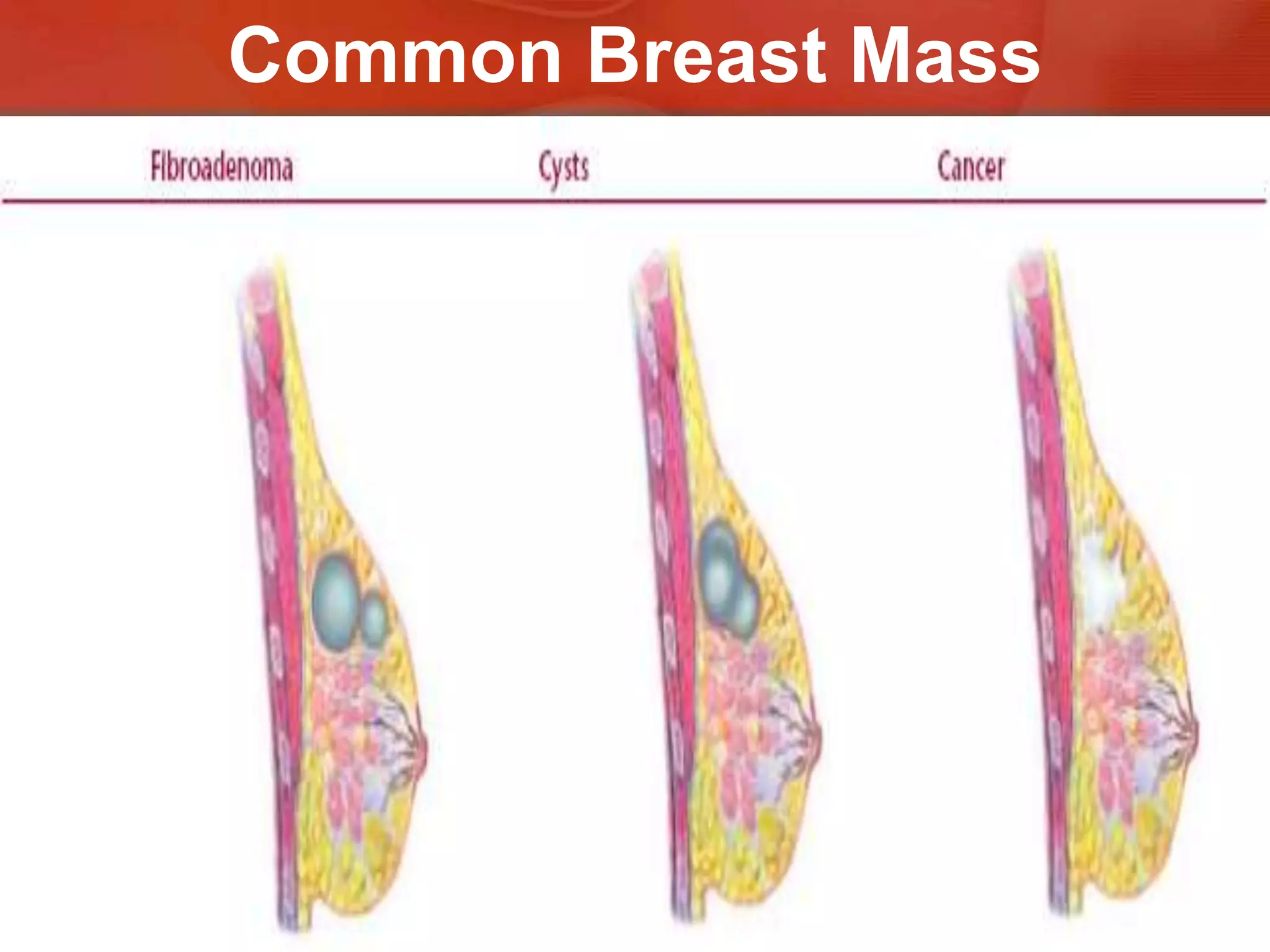 Examination of The Mastectomy PatientMassesNodularityChange in color or inflammation