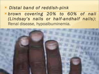 Distal band of reddish-pink brown covering 20% to 60% of nail (Lindsay’s nails or half-andhalf nails) :  Renal disease, hypoalbuminemia. 
