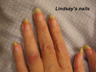 Lindsay’s nails  