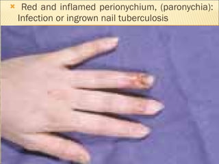 Red and inflamed perionychium, (paronychia): Infection or ingrown nail tuberculosis 