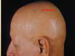 Alopecia   