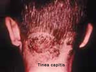 Tinea capitis  