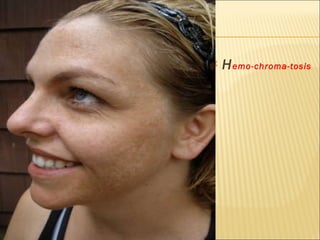 H emo-chroma-tosis 