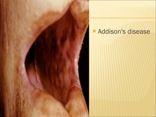 Addison's disease  