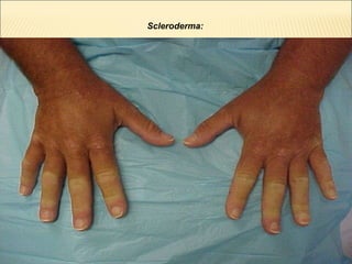 Scleroderma:   