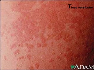 T inea versicolor 