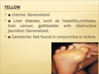 ■  Uremia: Generalized. ■  Liver disease, such as hepatitis,cirrhosis, liver cancer, gallbladder with obstructive jaundice: Generalized. ■  Carotemia: Not found in conjunctiva or sclera. 