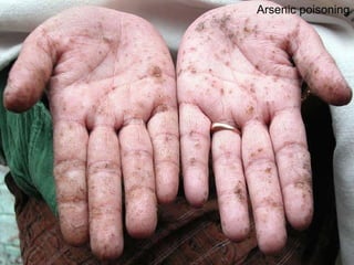 Arsenic poisoning 