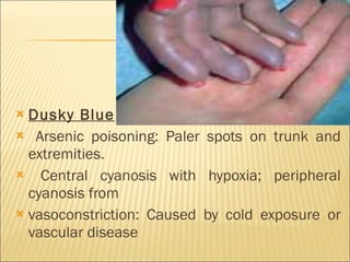 Dusky Blue Arsenic poisoning: Paler spots on trunk and extremities. Central cyanosis with hypoxia; peripheral cyanosis from vasoconstriction: Caused by cold exposure or vascular disease 
