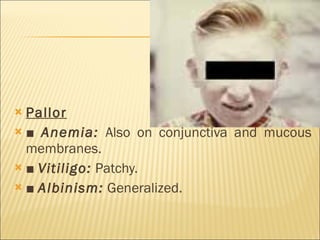 Pallor ■  Anemia:   Also on conjunctiva and mucous membranes. ■  Vitiligo:   Patchy. ■  Albinism:   Generalized. 