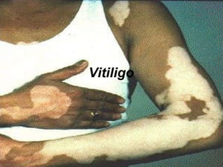 Vitiligo 