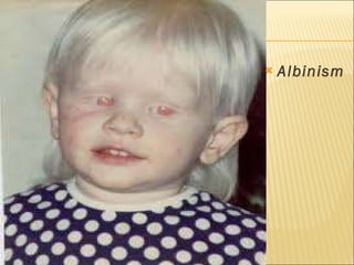 Albinism 