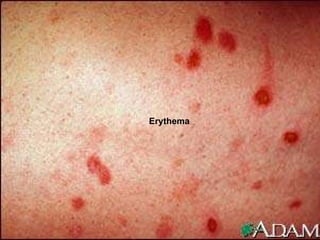 Erythema 