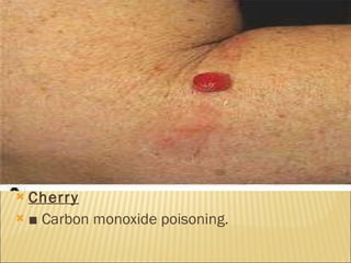 Cherry   ■  Carbon monoxide poisoning. 
