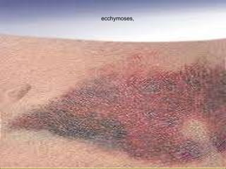 ecchymoses,  
