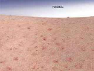 Pattechiae 