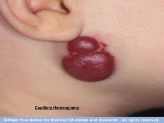 Capillary Hemangioma   