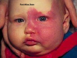 Port-Wine Stain   