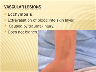 Ecchymosis   Extravasation of blood into skin layer. Caused by trauma/injury. Does not blanch. 