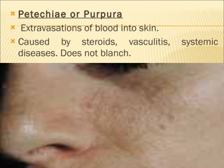Petechiae or Purpura Extravasations of blood into skin. Caused by steroids, vasculitis, systemic diseases. Does not blanch. 