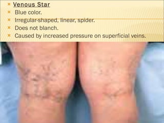 Venous Star Blue color. Irregular-shaped, linear, spider. Does not blanch. Caused by increased pressure on superficial veins. 