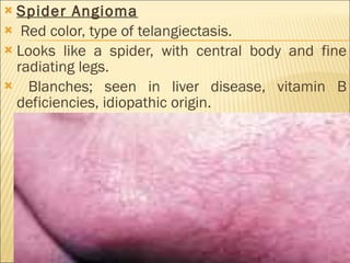 Spider Angioma Red color, type of telangiectasis. Looks like a spider, with central body and fine radiating legs. Blanches; seen in liver disease, vitamin B deficiencies, idiopathic origin. 