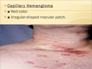 Capillary Hemangioma ■  Red color. ■  Irregular-shaped macular patch. 