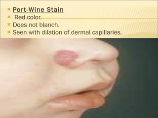 Port-Wine Stain Red color. Does not blanch. Seen with dilation of dermal capillaries. 