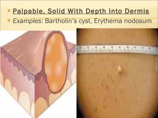 Palpable, Solid With Depth Into Dermis Examples : Bartholin’s cyst, Erythema nodosum 
