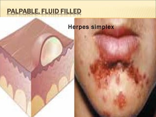 Herpes simplex 