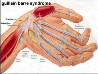 guillain barre syndrome
 