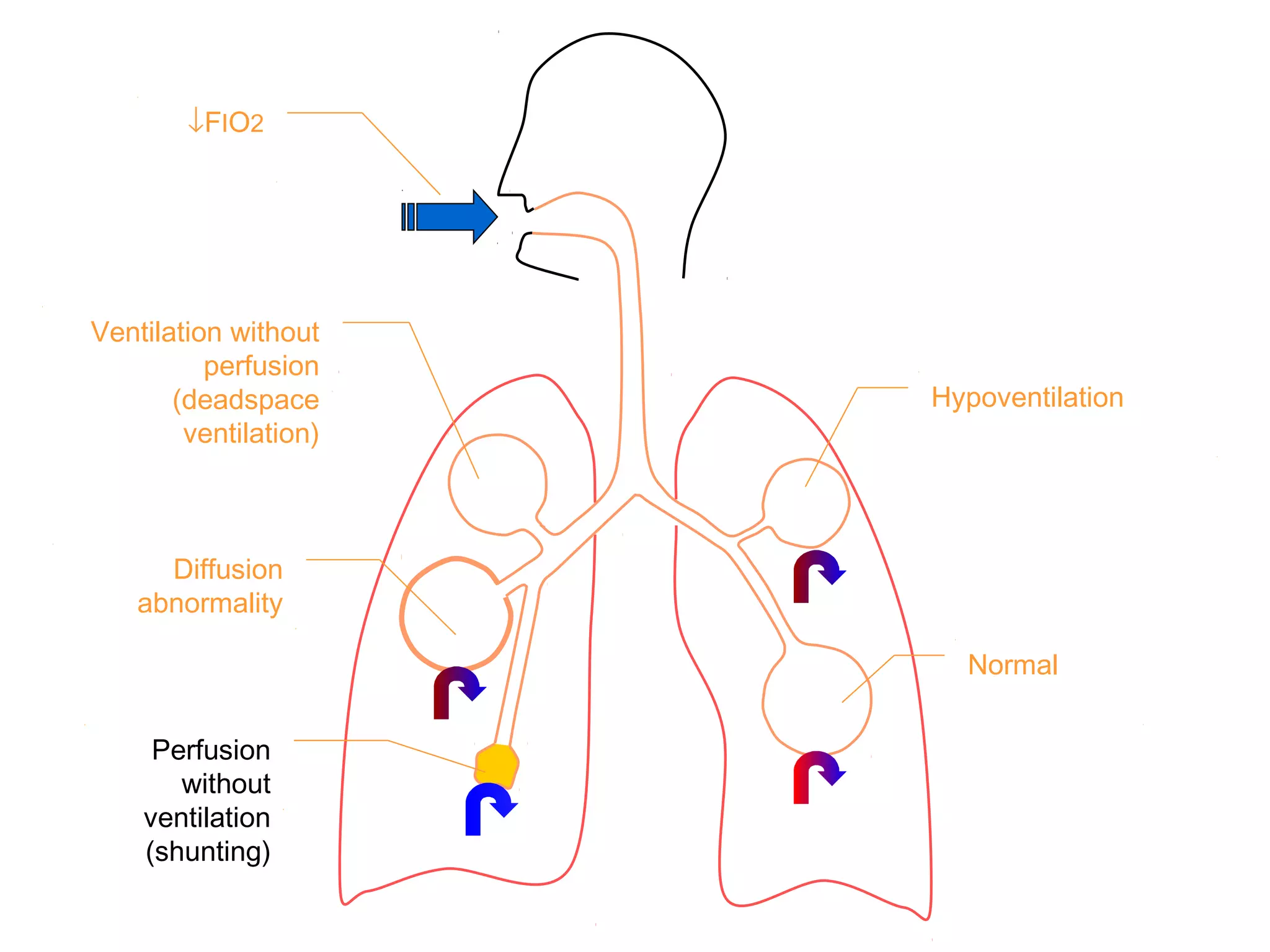 ↓FIO2
Ventilation without
perfusion
(deadspace
ventilation)
Diffusion
abnormality
Perfusion
without
ventilation
(shunting)
Hypoventilation
Normal
 
