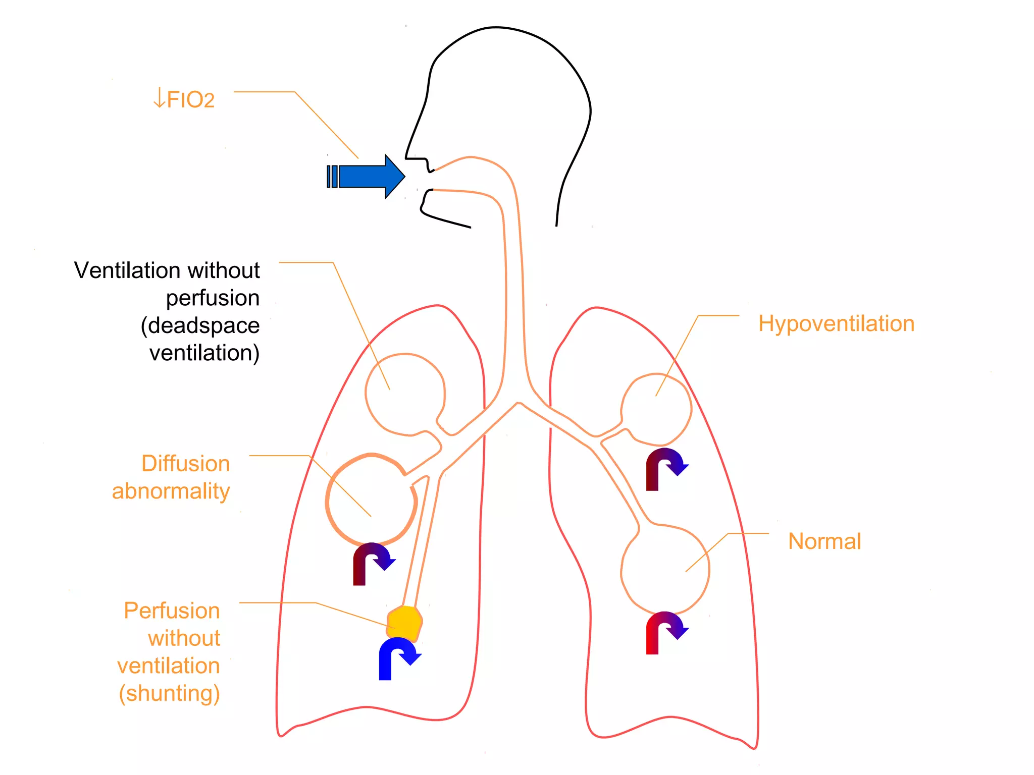 ↓FIO2
Ventilation without
perfusion
(deadspace
ventilation)
Diffusion
abnormality
Perfusion
without
ventilation
(shunting)
Hypoventilation
Normal
 
